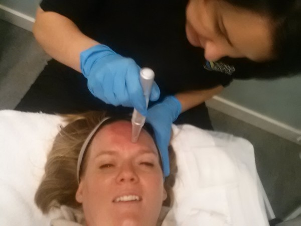 What is Derma Pen?